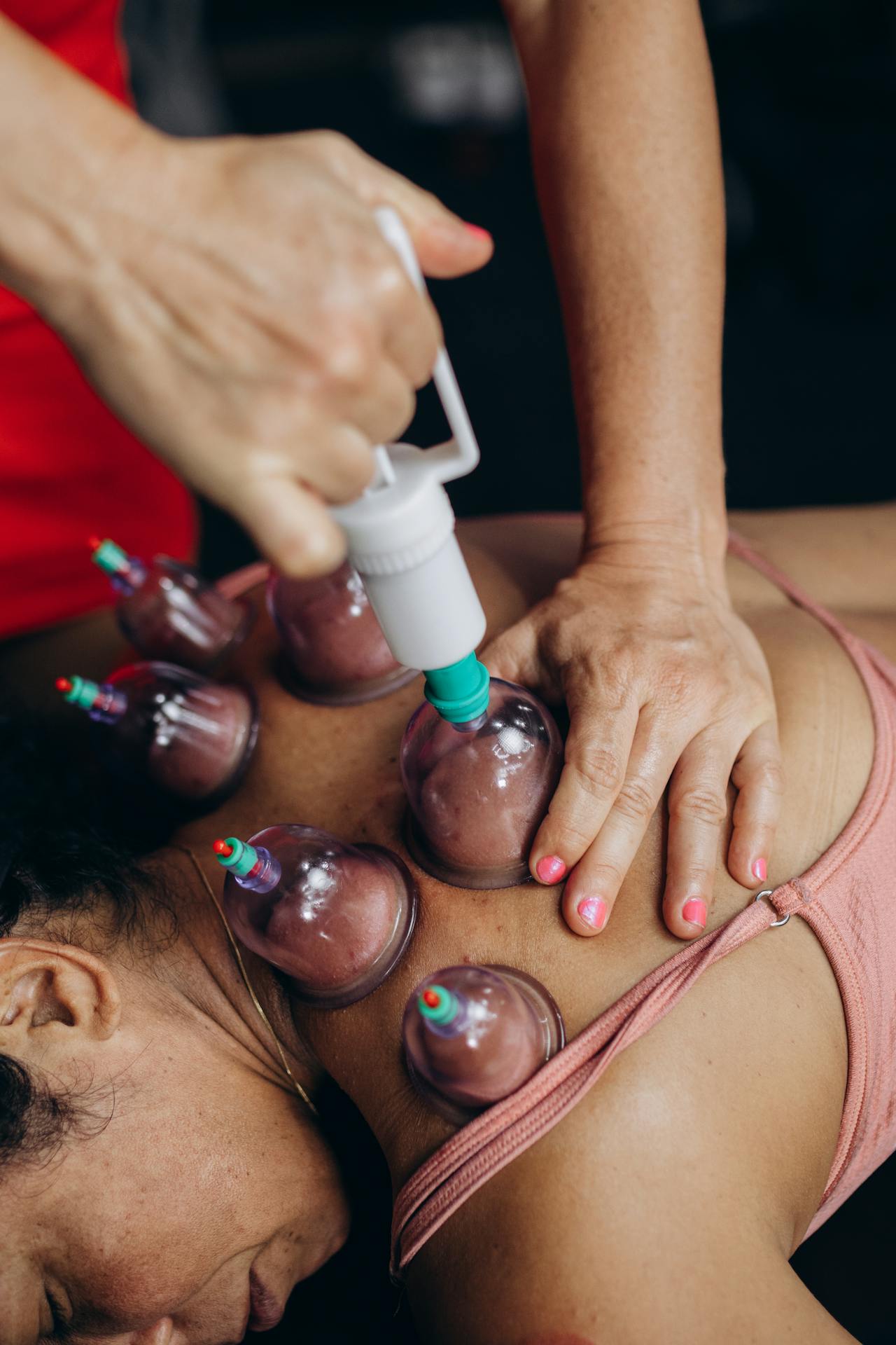 Chiropractic + Cupping + Dry Needling